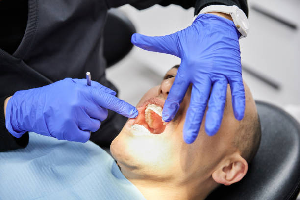Best Emergency Wisdom Teeth Removal in Mila Doce, TX